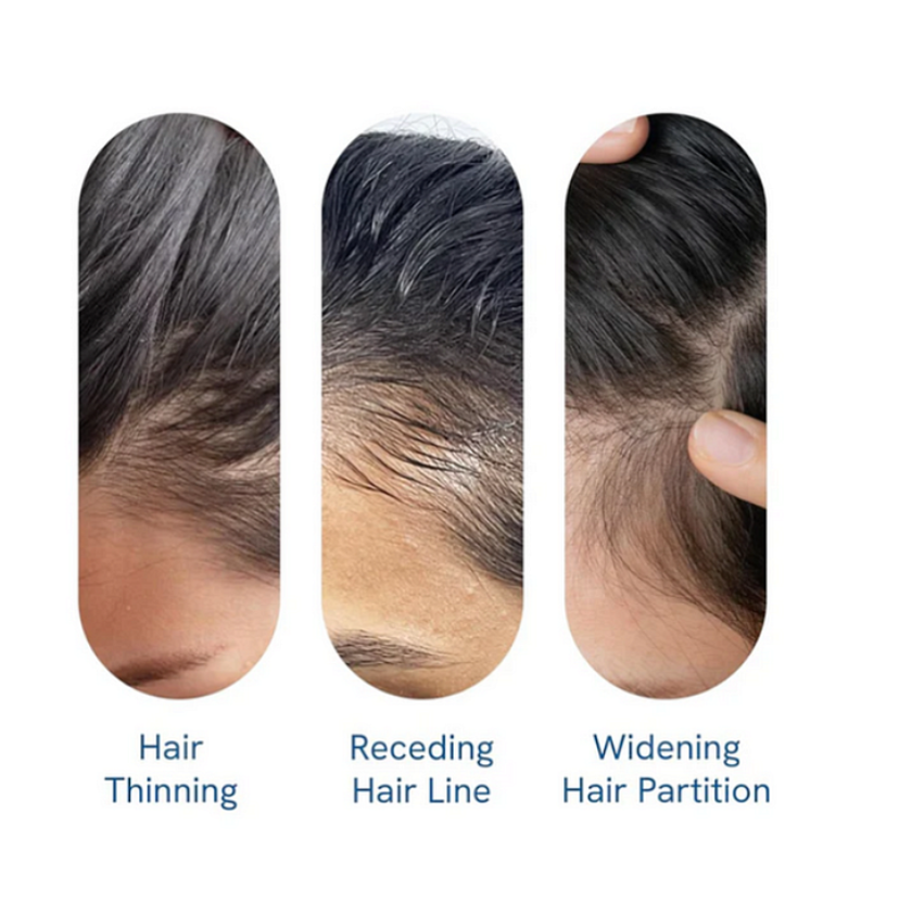 Be Bodywise Advanced Hair Growth Roll-On Serum | 3% Rosemary | 2% Aminexil | 3% Redensy l 2% Anagain | Precision Scalp Applicator | Paraben & Sulphate Free | Non oily and mess free-HHW
