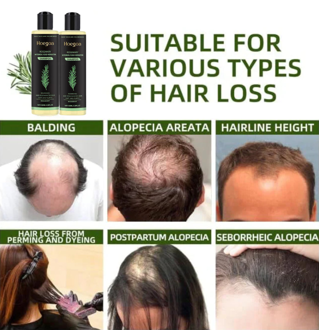 Urgent!🌿 Rosemary Oil Shampoo Works – Hair Growth Starts Now!-XDX