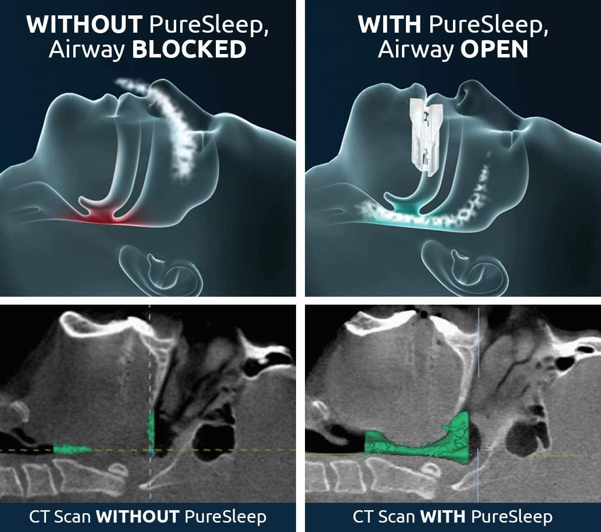 The Original Anti-Snoring Mouthpiece and #1 Solution Worldwide-XDX