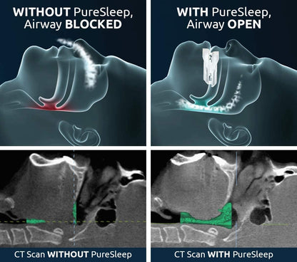 The Original Anti-Snoring Mouthpiece and #1 Solution Worldwide-XDX